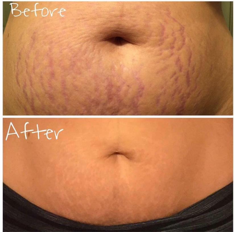 Body-care routine — stretch-mark care