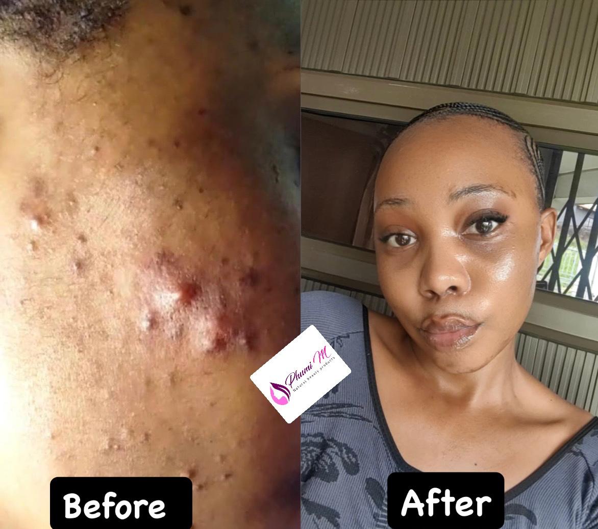 Face-care routine — blemish recovery